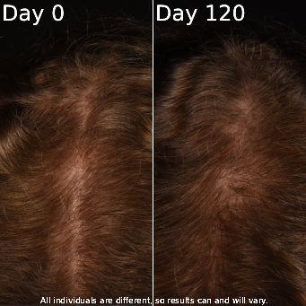 Top-down scalp photos comparing Day 0 and Day 120 showing increased hair density at the crown with overlaid labels Day 0 and Day 120