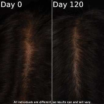 Before-and-after scalp photographs showing hair appearance at Day 0 and Day 120