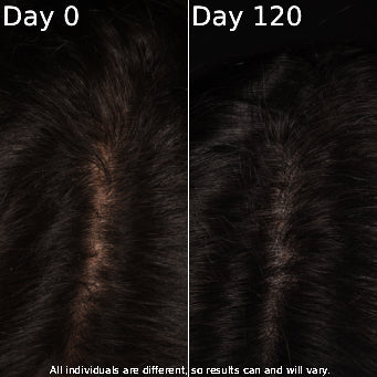 Before and after scalp photos labeled Day 0 and Day 120 showing changes in hair coverage