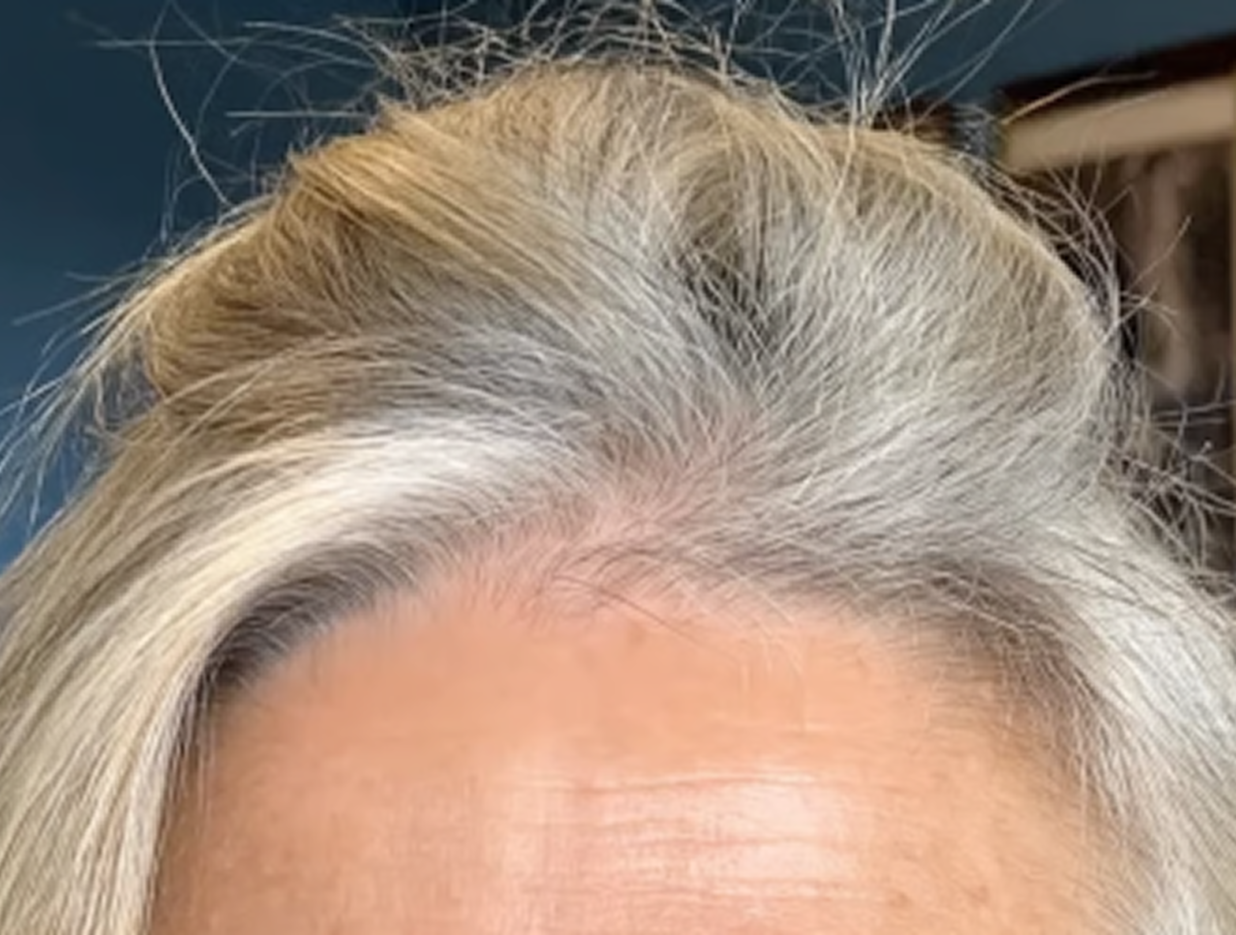 Close-up of a person’s scalp and hairline after treatment showing fuller-looking hair with a neutral blue background