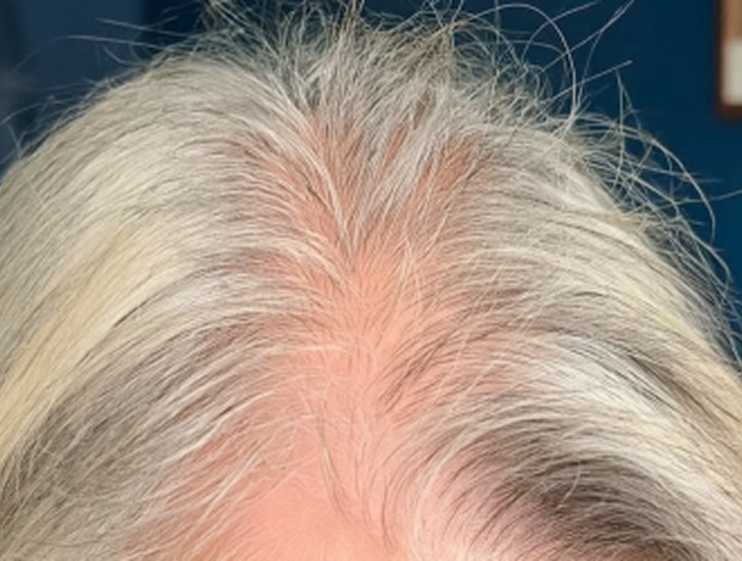 Close-up of thinning gray hair with visible scalp at the center part against a dark blue background