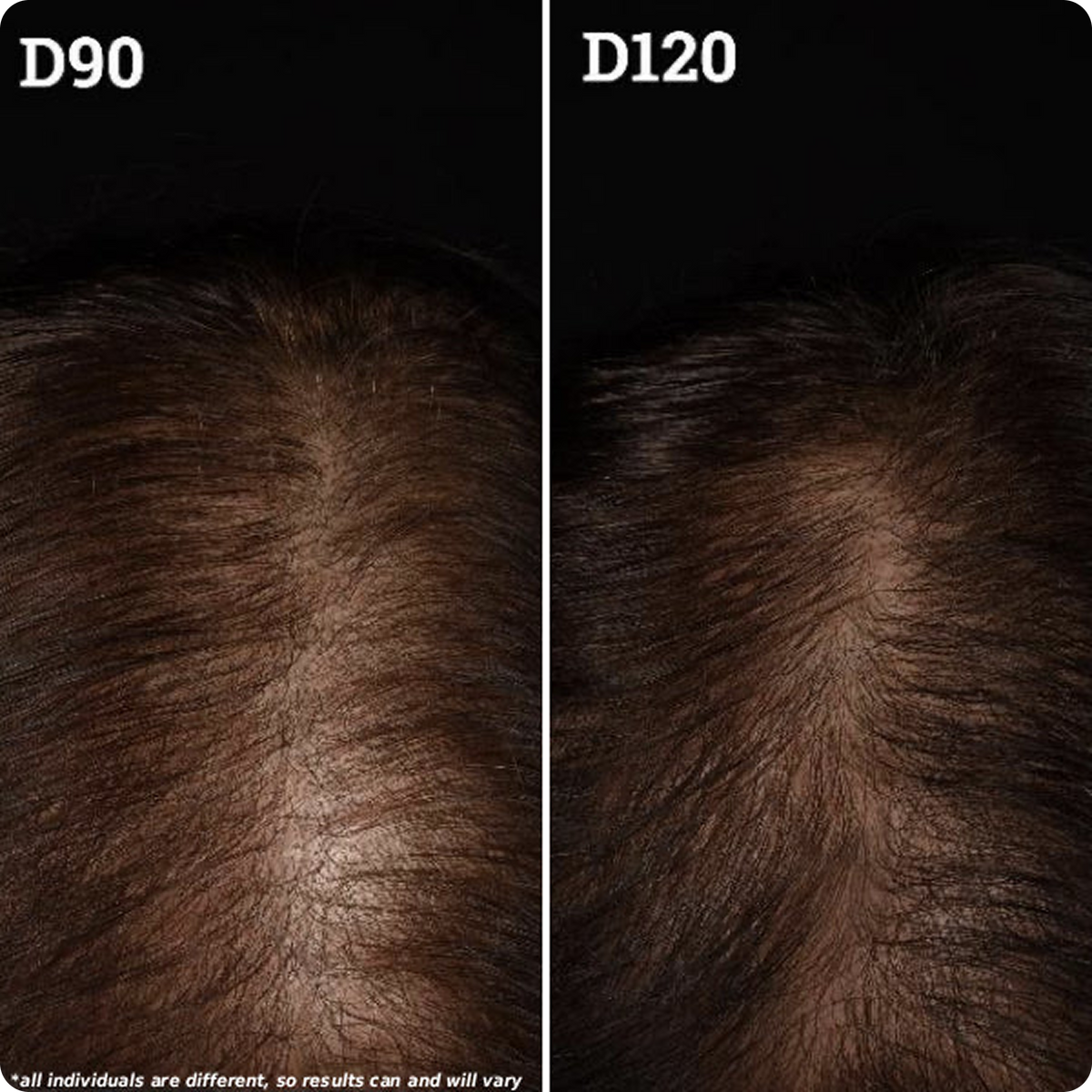 Top-down comparison of a thinning scalp showing increased hair density from D90 to D120 after treatment