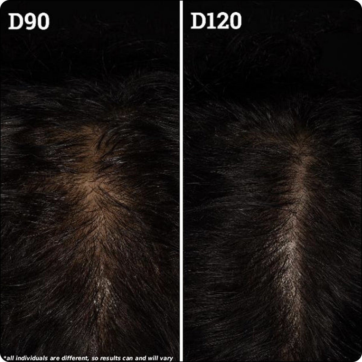Close-up scalp before-and-after showing increased hair density, left labeled D90 and right labeled D120
