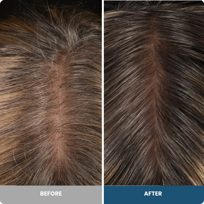 Before and after, left to right: top of scalp with a widened thinning part on the left and fuller hair with a narrower part on the right