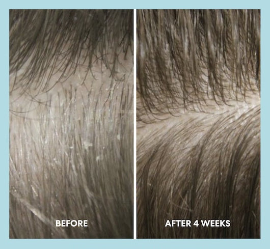 Before and after comparison of hair treatment with 'Before' showing dirty hair and 'After 4 Weeks' showing cleaner hair.