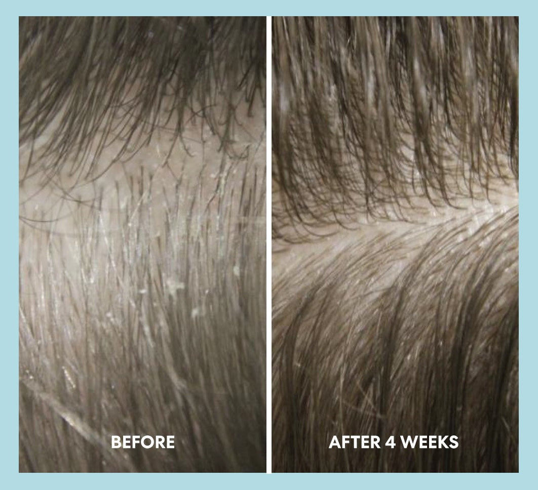 Close-up scalp before and after using the shampoo, left labeled "BEFORE" with visible flakes, right labeled "AFTER 4 WEEKS" with reduced flakes